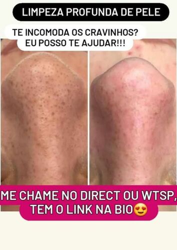 Antes e depois